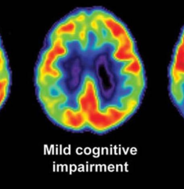 brain scan of mild cognitive impairment